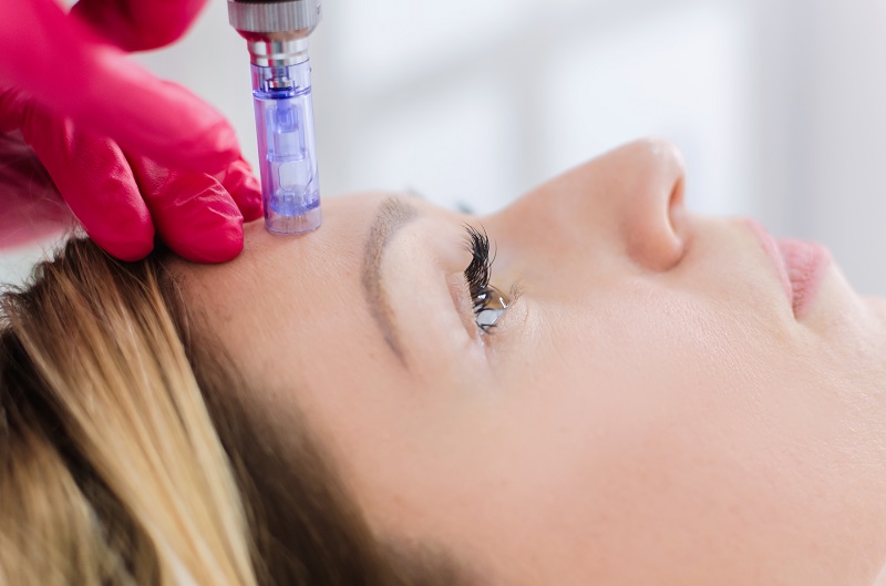 MicroNeedling » Acupuncture Center, Inc. Acupuncturist in Poway, CA