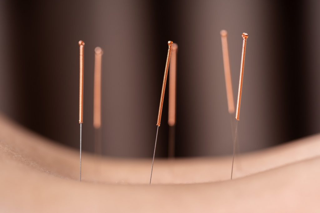 close up of copper acupuncture needles