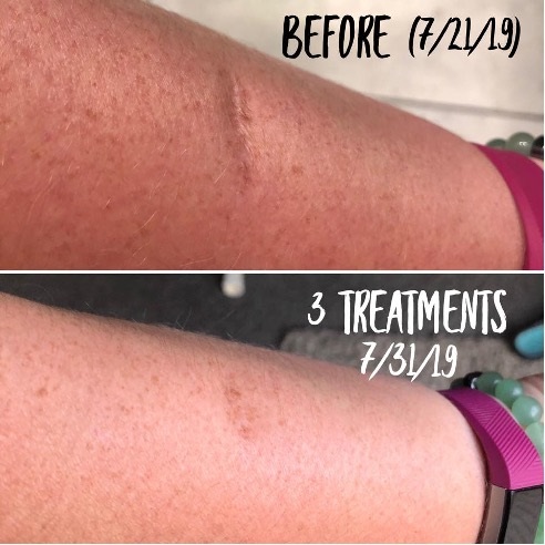 scar therapy results